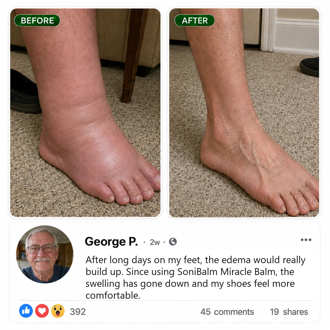 Before and after using SoniBalm, George P.