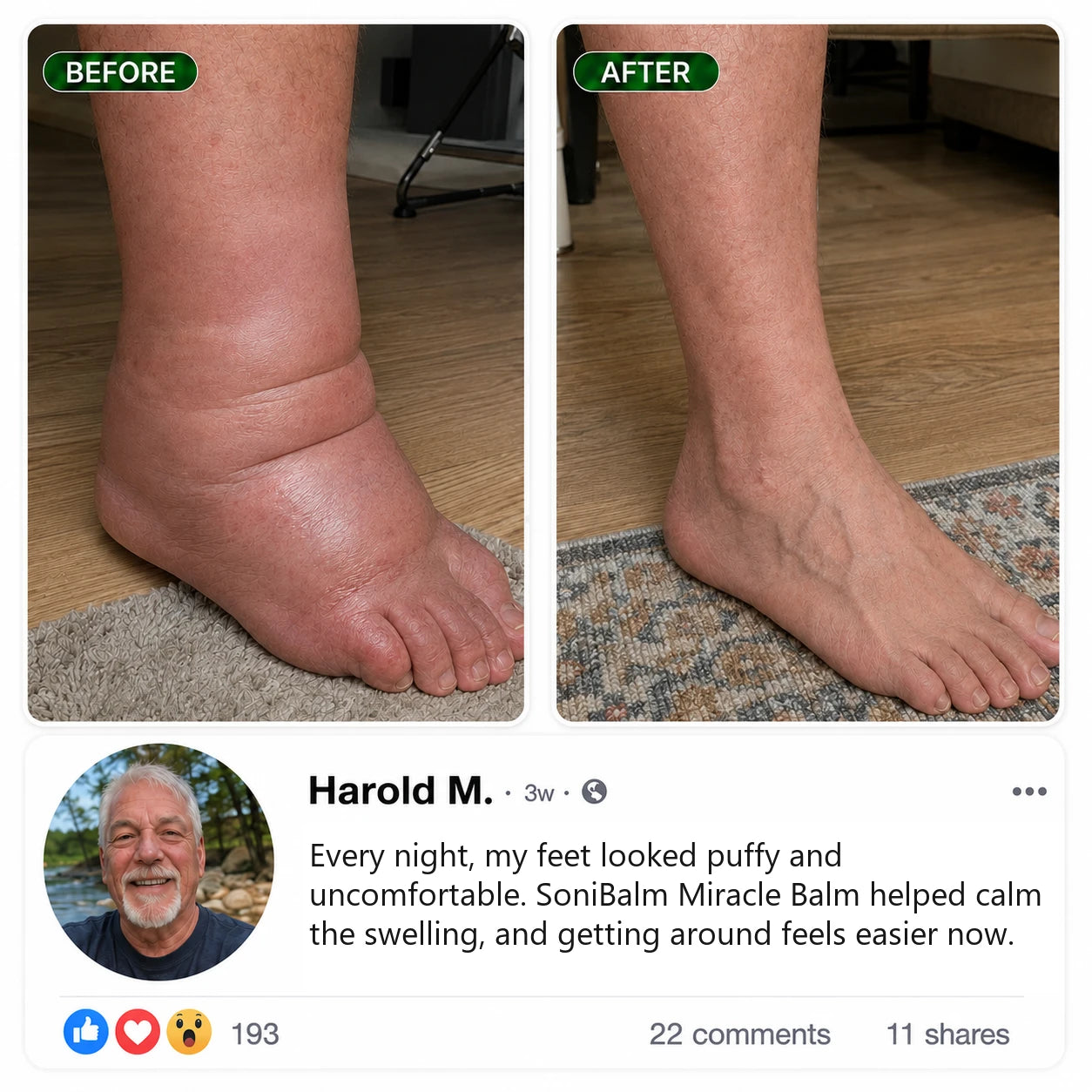 Before and after using SoniBalm, Harold M.